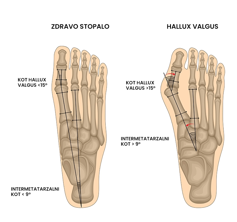 Hallux valgus