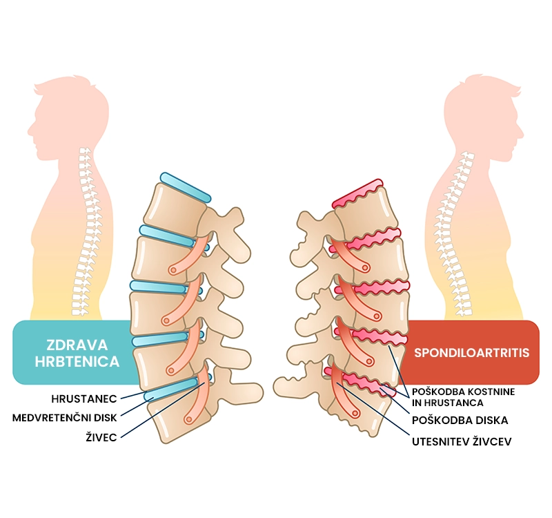 Osteoartritis hrbtenice (spondiloza)