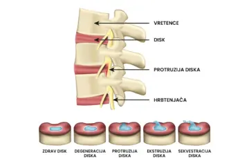 Protruzija-vs-hernija