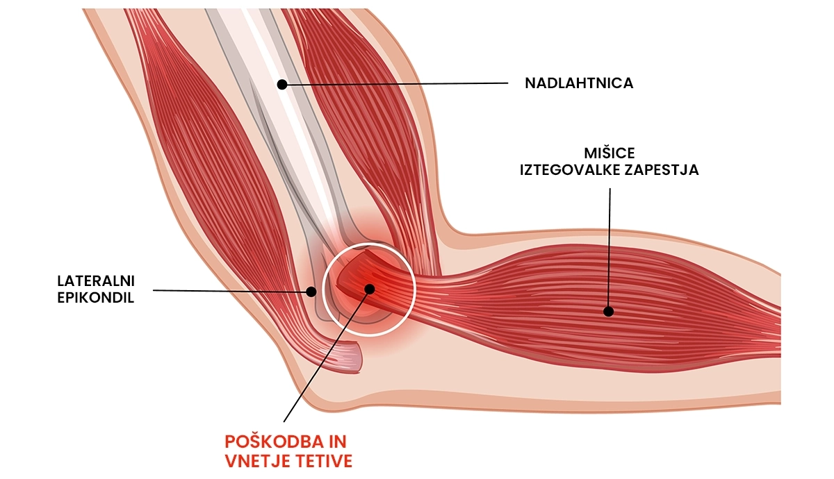 Vneta tetiva pri teniškem komolcu