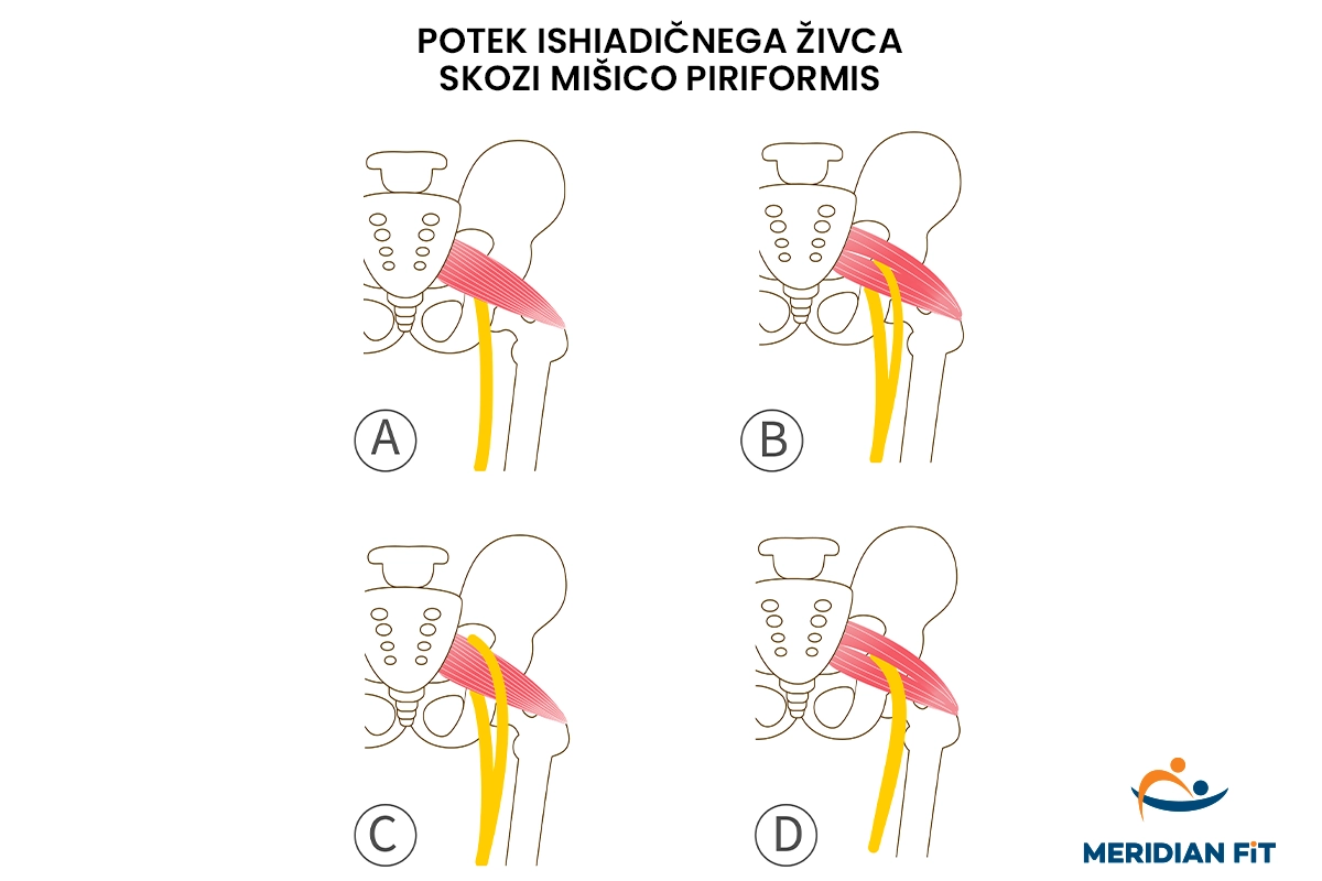 potek ishiadicnega zivca