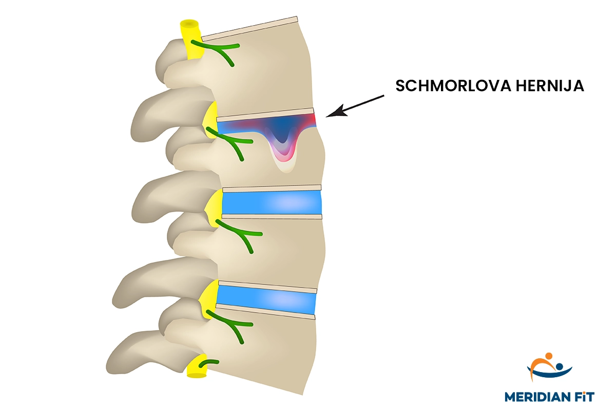 ugreznina v vretencu pri schmorlovi herniji