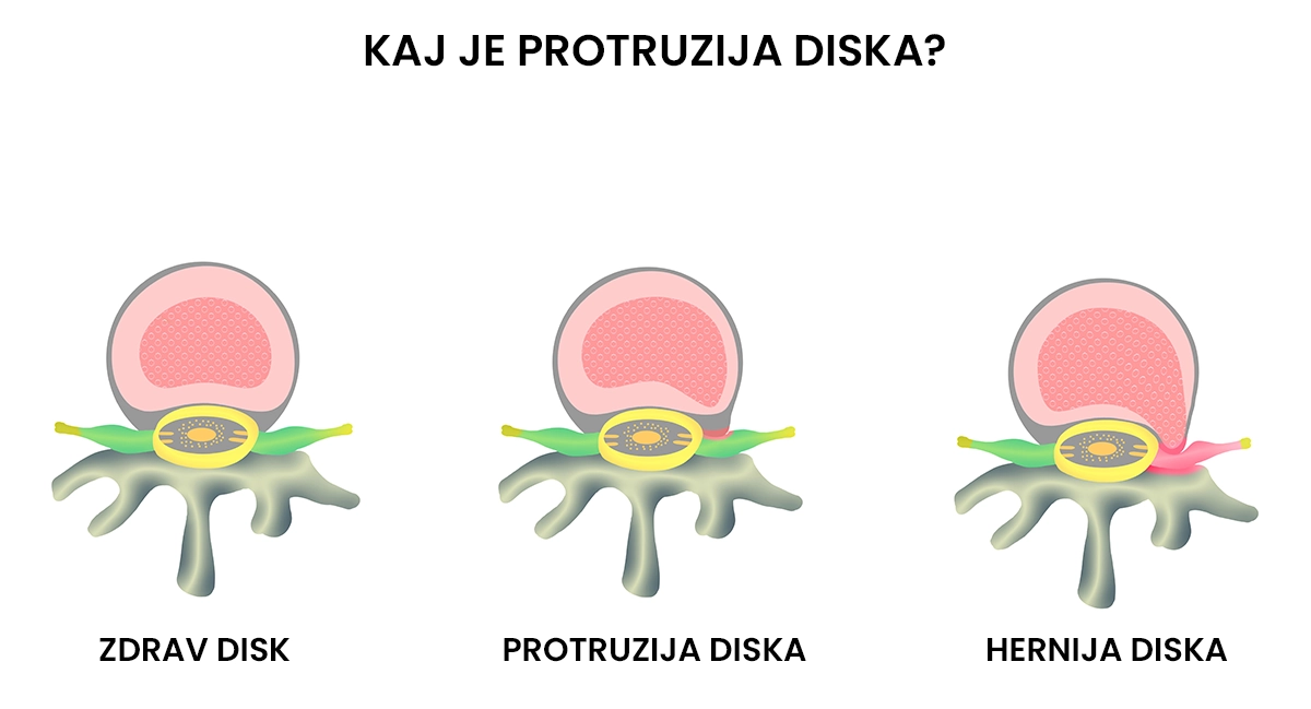 kaj je protruzija diska