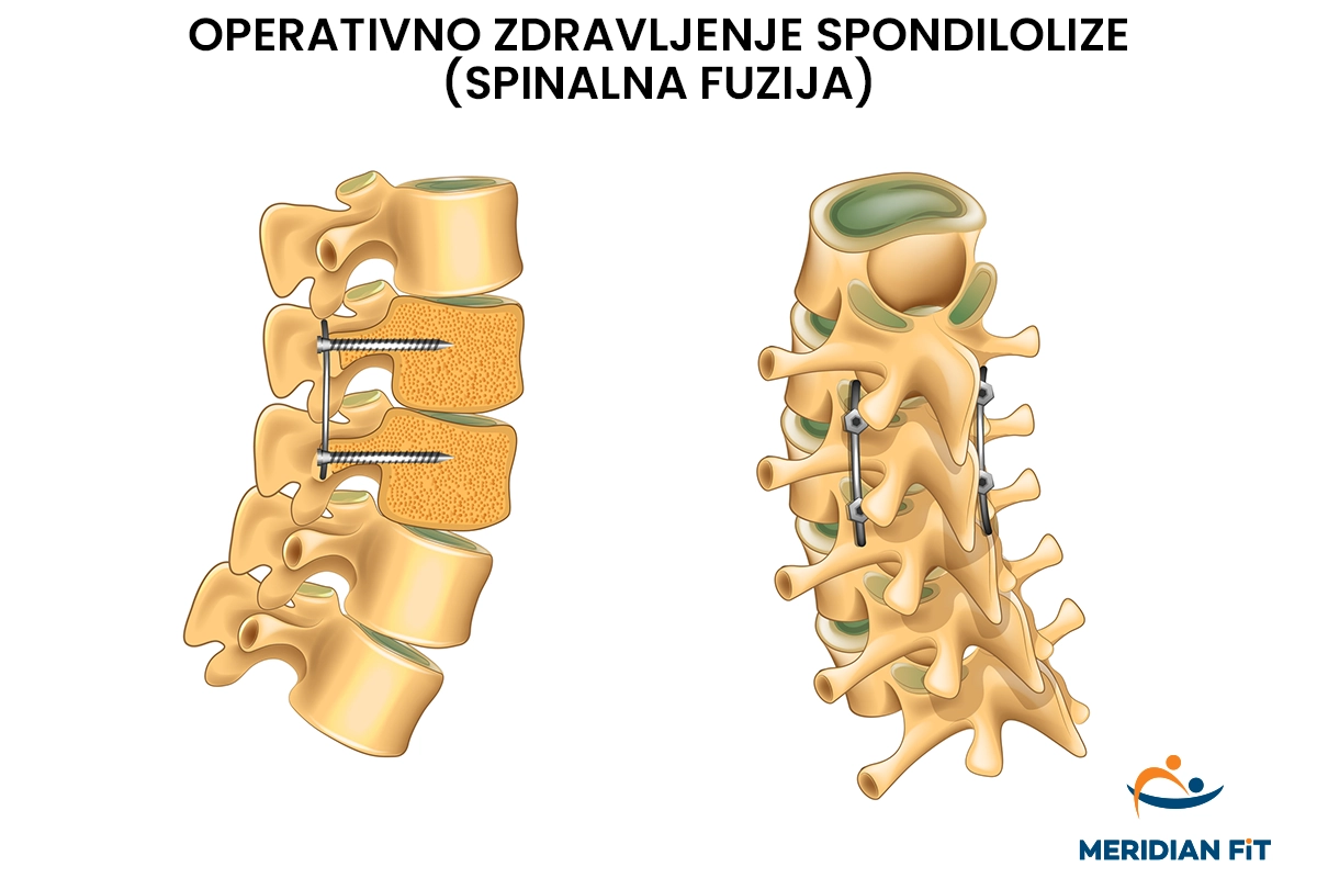 operativno-zdravljenje-spondilolize